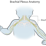 
			

Facing the challenges of a brachial plexus birth injury lawsuit can feel overwhelming. The reason is that when babies experience injuries to the nerves in their shoulders during birth, families might seek legal help to understand their options. 



This lawsuit is about getting money because of problems during birth that caused these nerve injuries. So, knowing what this lawsuit involves can help families understand how to deal with the legal stuff better. Scroll down to find out more details regarding this lawsuit!



What Is Brachial Plexus?



According to Hopkins Medicine, the brachial plexus is a complicated bundle of nerves that run from the neck to the shoulders. These nerves are responsible for making muscles work in the chest, shoulders, arms, and hands. Moreover, they also help us feel things in our upper limbs, like touch and sensation.



What Is Brachial Plexus Birth Injury?



The brachial plexus is a bunch of nerves near the neck and shoulders that help us feel and move our upper body parts like the chest, shoulders, arms, and hands. When these nerves get pulled, pressed, or torn, it’s called a brachial plexus injury. This can happen during birth and occurs in about one to three out of every 1,000 births.




If the brachial plexus is slightly pulled, the baby might have a small problem that gets better after a few months. But if there’s a bigger injury, the child might have ongoing issues like:




weakness in the arm or hand;



less movement or feeling in the arm or hand;



some parts of the body are unable to move;



an arm that stays bent toward the body.




Doctors treat these injuries with therapy, medicine, and sometimes surgery. But for some kids, it might mean having a long-lasting problem. This type of injury is a common problem in medical mistakes that can lead to serious consequences.



What Are the Causes?



Brachial plexus injuries often happen during a baby’s birth. They occur when the baby’s head or shoulders get stuck while coming out, causing stretching or tearing in the nerves around the neck. This can also occur if the baby’s head is pushed to one side during birth.



These injuries might be due to factors like the baby’s size, difficult or long labor, and the use of tools like forceps or vacuums. Additionally, it can also happen if the doctor applies too much force while delivering the baby. 



If you think your child’s brachial plexus injury happened because of a mistake by a doctor, it could be considered medical malpractice. Therefore, you can consider talking to a birth injury lawyer to understand your options for filing a brachial plexus birth injury lawsuit.



How Do Doctors Find Brachial Plexus Injuries?



Basically, doctors will check the baby’s hand and arm. They’ll check how they feel and move to spot a brachial plexus injury. However, they might also use the following tests for a more thorough examination.



1. An X-ray to check for any broken bones or injuries around the nerves in the neck and shoulder.



2. Imaging tests, like MRI or CT scans, might use dye to show any injuries to the brachial plexus nerves.



3. Test with needle electrodes to see how the nerves work, like a nerve conduction study and electromyogram.



Settlement for Brachial Plexus Birth Injury Lawsuit 



If your child has a brachial plexus injury, seeking compensation may help. You might wonder how much money similar cases receive. On average, settlements in ten examples exceeded $2 million. However, every injury is different, so this average doesn’t give a clear picture.



7 Steps to File a Brachial Plexus Birth Injury Lawsuit



It’s essential to act quickly if you want to start filing for legal action concerning brachial plexus birth injury. Here are the seven necessary steps to take!



1. Thinking of the Time Limit



First, you should file a medical malpractice lawsuit for brachial plexus injuries quickly. Each state has a time limit, called a statute of limitations, to file. Thus, mind the time criteria because if this time has passed, you can’t file the lawsuit anymore.



2. Consulting a Lawyer



Speak with a brachial plexus lawyer who can assess your claim’s strength before starting the brachial plexus birth injury lawsuit. They’ll compare the doctor’s actions during childbirth to the standard medical care. 



This means checking if the doctor acted like a skilled doctor would’ve in that situation, based on available medical info at that time.



3. Evaluating Doctor’s Actions 



It’s really important to find out if the doctor not doing what they should have done which led to the injury. You can check if the doctor’s actions are legally responsible for causing the harm. Basically, figuring this out is a key part of understanding what happened.



4. Gathering Evidence



You and your lawyer must gather evidence to prove your child’s injury was preventable. The evidence includes documenting events before, during, and after birth, collecting medical records, bills, and photos, noting known risks, and identifying witnesses and medical experts.



5. Determining Case Value



Assess the future treatment needs for your child’s injury. For instance, you can plan and calculate the medical costs your child may face throughout life. This way, you can estimate the compensation needed for your case.



6. Lawsuit Process



You need to know that once the brachial plexus birth injury lawsuit starts, it typically takes eighteen months to two years. The duration itself depends on numerous factors, such as jurisdiction, claimed damages, expert involvement, accessibility of medical records, and witness availability.



7. Settlement or Trial



Lastly, your lawsuit can either settle out of court or go to trial. In settlements, the doctor offers compensation to avoid negative publicity and the costs of a trial. Meanwhile, trials may result in higher compensation but aren’t a guaranteed win.



Now You Know How to File a Brachial Plexus Birth Injury Lawsuit!



By filing a brachial plexus birth injury lawsuit, you can seek justice for your child’s injury. The explanation equips you with the essential knowledge to navigate this legal process.



However, always remember that each case is unique, so follow the steps based on your specific situation and consult with an expert in the field. Hence, by taking these steps, you can confidently pursue the necessary actions to secure the best possible outcome for your child.


		