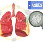 
			

Mesothelioma law firms Houston may be essential to know if you have asbestosis. For your information, asbestos is a fibrous mineral that often produces powder or dust. When you accidentally ingest or inhale it, the fibers can stay in internal organs and slowly develop a tumor. Let’s look at a brief definition of the ailment below!



Definition of Mesothelioma



From the passage above, you were briefly informed about asbestosis. Then, what about mesothelioma? Mesothelioma is an aggressive type of cancer that develops after asbestos exposure. When a person gained an asbestos exposure, the chance he would get a mesothelioma will be higher.



Physicians suggest some types of treatment that can help improve survival and quality of life since mesothelioma survival ranges from 18 to 31 months. Doctors will likely ask the patients for chemotherapy or immunotherapy for better results.



5 Mesothelioma Law Firms Houston for You



Since mesothelioma disease is dreadful for those who suffer from it, you may want to know better about some law firms that can help you get compensation. Here are the five best law firms in Houston specializing in mesothelioma cases.




1. BCBH Law



Bullock Campbell Bullock & Harris, or BCBH Law, is a national asbestos law firm that offers you experienced and skilled lawyers to handle specific cases, especially mesothelioma cases. The attorneys at BCBH will assist you in specifying where you need to submit your claim, like in Houston or three other states.



Since BCBH is a national law firm, you can gain efficiency and convenience in handling your case as you will have only an attorney for all your claims.



2. Amaro Law Firm



Besides BCBH Law, one of the best mesothelioma law firms Houston is called Amaro Law Firm, as it’s ready to provide you with the necessary support, representation, and guidance. Amaro Law Firm can assist you wherever you are, not only in Houston, as long as you’re in the US.



Indeed, you may not be able to cancel a permanent loss; however, Amaro will do their best to seek all the possible financial recoveries. 



3. Meirowitz & Wasserberg



A free consultation at Meirowitz & Wasserberg regarding mesothelioma is possible. Not only a free consultation but Meirowitz & Wasserberg can also assist you in negotiating settlements on your behalf. Moreover, you can ask this law firm to represent you at a trial if required.



While your case may involve many defendants, you won’t need to worry, as the lawyers at Meirowitz & Wasserberg have extensive experience handling these cases. This law firm will protect your rights at all costs.



4. The Lanier



The other mesothelioma law firms Houston, The Lanier, offers a detailed investigation of your mesothelioma case. This law firm has numerous exceptional attorneys who will be able to handle your case, as they have a knack for negotiating. 



The Lanier can also meet you in person so you can have a thorough conversation with them. Don’t stress too much while trusting your case in The Lanier’s care, as they won’t demand any upfront fees. Instead, they’ll only charge a percentage of your compensation after you receive it entirely.



5. Simmons Hanly Conroy



Lastly, you can check Simmons Hanly Conroy as well. Simmons believes that people who suffer from mesothelioma deserve to claim their rights. Therefore, Simmons has successfully represented numerous families affected by this type of cancer and tried their best to give the utmost attention and respect.



Simmons is also an expert when it comes to a result. As one of the mesothelioma law firms in Houston, Simmons always ensures their clients get the results in 90 days or less. Their speed is one of the reasons why they became a leading law firm in Houston.



The Symptoms of Mesothelioma



You may face several symptoms if you have mesothelioma before a medical check-up. The symptoms depend on where the cancer occurs. The cancer can occur in tissue in the abdomen, and it also can happen in the lungs. Learn a brief explanation of the symptoms below. 



1. Peritoneal Mesothelioma



Peritoneal mesothelioma is a cancer that occurs in tissue in the abdomen. The symptoms that may appear include:




unnatural weight loss,



nausea,



pain in the abdomen area, and



abdominal swelling.




2. Pleural Mesothelioma



Pleural mesothelioma is a type of cancer affecting the tissue surrounding the lungs. Here is the list of the symptoms and signs:




shortness of breath,



unnatural weight loss,



chest pain,



continuous coughing, and



unexplained lumps of tissue under the chest skin.




3 Types of Mesothelioma



While all mesothelioma law firms Houston may cover all types of mesothelioma cases, it wouldn’t be wrong if you’re learning about mesothelioma types. There are three types of mesothelioma cancer: sarcomatoid, epithelioid, and biphasic.



1. Sarcomatoid Mesothelioma



The tumor contains sarcomatoid cells, which look like sarcoma cells. Sarcoma cells make up 10% to 20% of all mesothelioma diagnoses. For sarcomatoid mesothelioma therapy, it’s best to have immunotherapy rather than chemotherapy.



2. Epithelioid Mesothelioma



You may find epithelioid mesothelioma as the most common mesothelioma cell type. It is usually found in the skin and other ordinary tissues. Fortunately, this type of cancer responds well to treatment, so the probability of patients healing fast with regular treatment is high.



3. Biphasic Mesothelioma



The last type of mesothelioma cancer is biphasic mesothelioma. Its tumors contain a combination of sarcomatoid and epithelioid cells. Generally, this kind of tumor occurs in the peritoneum (abdominal lining) and pleura (lung lining). The best treatment will depend on the percentage of each cell type.



Pick Your Best Choice on Mesothelioma Law Firms Houston from Here!



Knowing about the definition of mesothelioma cancer, as well as the symptoms and types, you may feel the patients’ painful feelings. They may feel it’s no use getting to know several recommendations of law firms specializing in mesothelioma cases, as the tumor will continue to grow inside their bodies.



However, the mesothelioma law firms Houston may be an excellent choice for them to gain a financial right to pay medical bills. After all, the hopes that they may be healed from the dreadful cancer will rise once they have the money to cover it all. And, that hope is crucial for them to keep themselves trying their best.


		