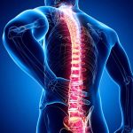 
                                                
Can spinal stenosis be caused by a car accident? The pain mentioned is often indicated through lower back pain. Also, a burning pain sensation when walking or standing that radiates from your buttocks to your feet. If you have had a car accident, you may wonder if the pain is caused by the accident. 



The spinal stenosis is a condition where the nerves or spinal cord are compressed. If you experience complaints as mentioned in the previous paragraph, don’t take them as trivial since they can have fatal consequences for your health. Be sure to stay in the loop so you get a comprehensive insight into spinal stenosis and its ins and outs.




What Is Spinal Stenosis?



The spine is segmented and has four parts, including cervical, thoracic, lumbar, and sacral. Stenosis is a part of the lumbar spine which is located in the lower back. The narrowing of the inside of the spinal column is called spinal stenosis.



Since the spinal cord contains the spinal cord and nerves, the narrowing will lead to compression of the cord and nerves. As a result, people who have spinal stenosis will feel pain in the lower back. Other symptoms are burning pain when walking or standing, numbness, neck pain, and tingling in the hands or feet.



Can Spinal Stenosis Be Caused by A Car Accident?



In point of fact, according to information on the Reich and Binstock page, car accidents do not cause spinal stenosis. However, accidents that cause spinal injury can worsen the condition of spinal stenosis.



If you have been experiencing spinal stenosis without symptoms, you may start to feel these symptoms as a result of an accident injury. Since some people who suffer from lumbar spinal stenosis do not feel the initial symptoms, they are not aware that they actually suffer from spinal stenosis.



As a result, symptoms such as those previously mentioned will appear after experiencing a traumatic accident.



In-Depth Exploration of Spinal Stenosis Causes



Can spinal stenosis be caused by a car accident? The answer is no, but a spinal injury resulting from an accident can worsen the symptoms of spinal stenosis, whether they are already felt or not yet felt. The Healthline page shares information on nine causes of lumbar spinal stenosis, as follows.



1. Spinal Injuries



Hard impacts can cause spinal injuries such as fractures of bone fragments. This condition can press on the nerves in the spine, causing pain. Pressure on the spine can also be caused by herniation in which the spinal discs slip.



2. Rheumatoid Arthritis



In addition to spinal injury, another factor that causes bone damage is rheumatoid arthritis. Chronic inflammation will cause bone spurs which can put pressure on the nerves and cord in the spine. Accordingly, you will feel symptoms of pain in the lower back.



3. Scoliosis



Since the question “Can spinal stenosis be caused by a car accident?” has been answered in the prior point, then another cause is scoliosis. Neurological disorders and genetic factors often cause an abnormally curved spine.



Given that the spine does not stand straight as it should, this abnormal curving can put pressure on the spinal cord or nerves. Hence, it leads to symptoms of spinal stenosis.



4. Spinal Tumors



Tumors developing in the spinal area can cause inflammation. In addition, tumors can change the condition of the surrounding bones. The growing size of the tumor will also put pressure on the nerves and spinal cord.



5. Congenital Spinal Stenosis



A naturally narrow spinal canal usually occurs due to congenital factors. Thus, babies born with congenital spinal stenosis will be more susceptible to experiencing symptoms of lower back pain, tingling of the hands and feet, or neck pain as they grow older.



6. Osteoarthritis



Although you have already gotten the answer to the question “Can spinal stenosis be caused by a car accident?”, you also need to find out other causes for proper treatment. Osteoarthritis is also often the cause of spinal stenosis problems.



Each spinal column has a joint cushion in the form of cartilage to absorb shock when the body moves. Osteoarthritis is a condition where the joint cushions are damaged so the spine develops bone spurs. These bone spurs can cause pain since they press on the nerves or spinal cord.



4 Risks Lurking Untreated Spinal Stenosis



You should not ignore the slightest health complaint since this condition can have fatal consequences if untreated. AICA Orthopedics shares four risks lurking if you ignore the symptoms of spinal stenosis in the following details. 



1. Disability



The reason why you should not ignore the symptoms of spinal stenosis is that it can cause permanent disability in severe conditions. Accordingly, permanent disability will require the sufferers to use a wheelchair for the rest of their lives because of the paralysis that makes them unable to stand.



2. Loss of Bowel and Bladder Control



The prior paragraph explanation no longer makes you wonder about the answer to the question “Can spinal stenosis be caused by a car accident?”, right?



Yet, untreated spinal stenosis will make the sufferers unable to control the bowel and bladder, also known as incontinence. Along the line, they will pass stool or urinate without realizing it.



3. Decreasing Activity



Since the narrowing of the spinal canal causes pain during activities, if you do not get the medical proper treatment it can reduce your activity and productivity. People suffering from the disease are uncomfortable doing activities such as walking, swimming, riding a bicycle, or activities that involve other physical movements.



4. Pain and Discomfort



Pain that comes and goes is a common symptom of spinal stenosis. However, the pain and discomfort will worsen over time. Since this pain radiates to other parts of the body, it will certainly make it difficult for you to live your life if you don’t get proper treatment immediately.



What Should I Do If a Car Accident Worsens My Spinal Stenosis?



Since you already grasp the firm answer to the question, “Can spinal stenosis be caused by a car accident?”, it does not mean that it has no effect at all. Rather, impacts due to car accidents can worsen the condition of people who have spinal stenosis. 



Therefore, if after an accident your health condition continues to worsen due to spinal stenosis, it is time for you to reach out to a personal injury lawyer. You can ask your lawyer to assist you in filing an accident claim that caused you to experience adverse health or permanent disability. 



The legal action allows you to get compensation for your well-being and financial losses due to not being able to work.
                        
                                                
                    